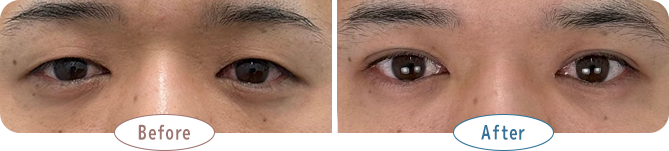 【重いまぶた】眠たそうな目元が、明るく華やかに