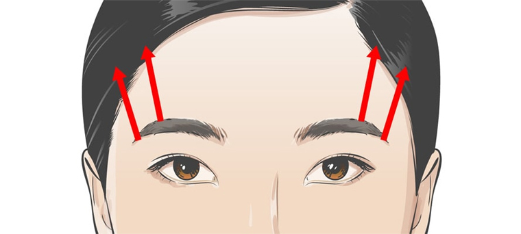 切らない眉上リフト イメージ1