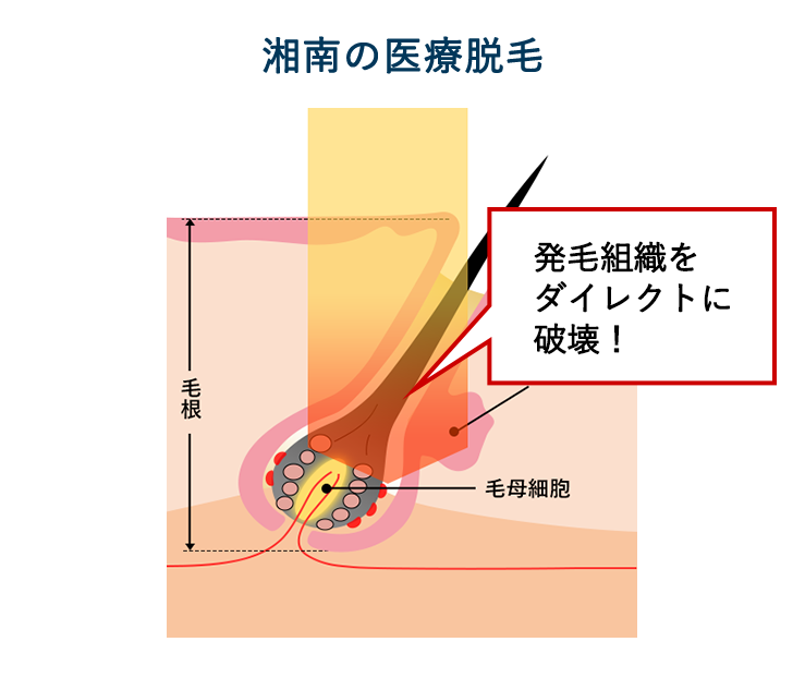 湘南の医療脱毛