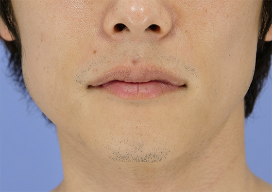 男性脱毛 ヒゲ 症例写真 6回目照射から2か月後（剃毛していない状態）
