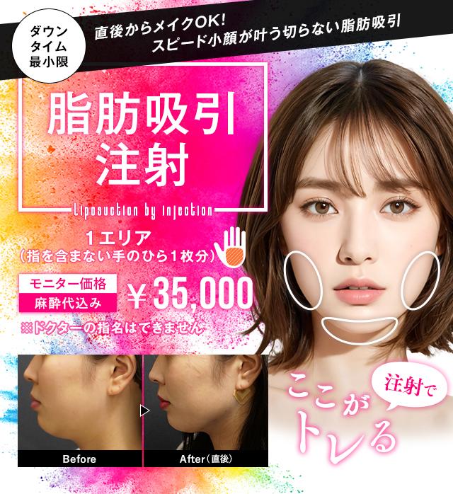 小顔用脂肪吸引注射
