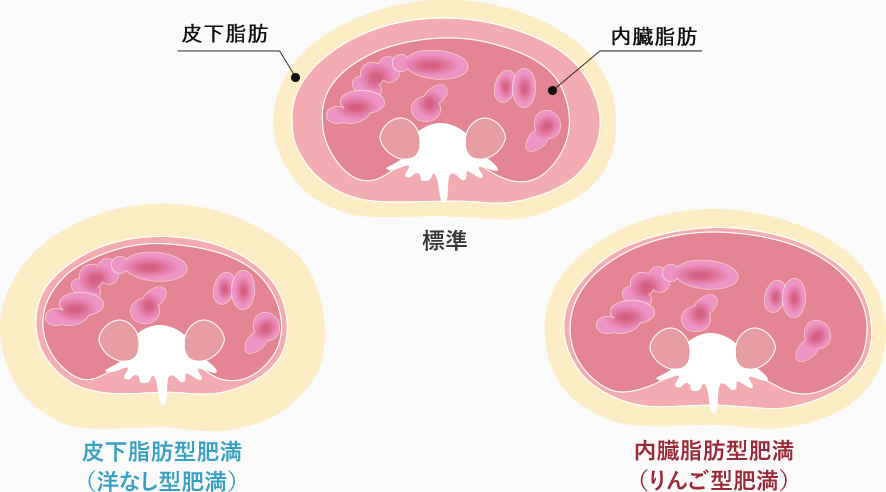 皮下脂肪型肥満と内臓脂肪型肥満