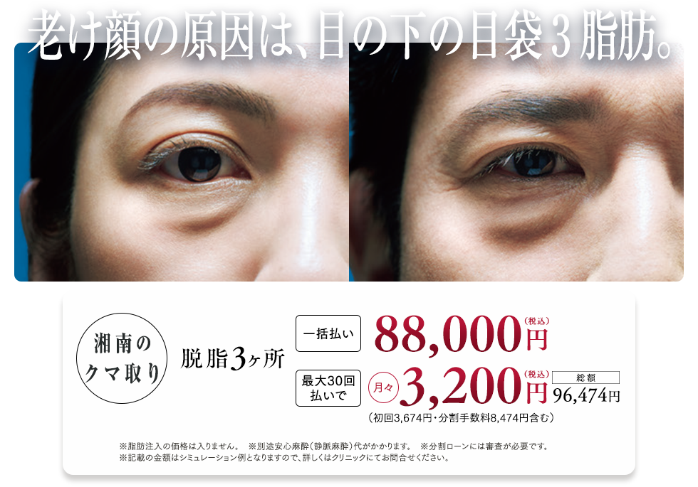 目の下の切らないクマ・たるみ（ふくらみ）取り