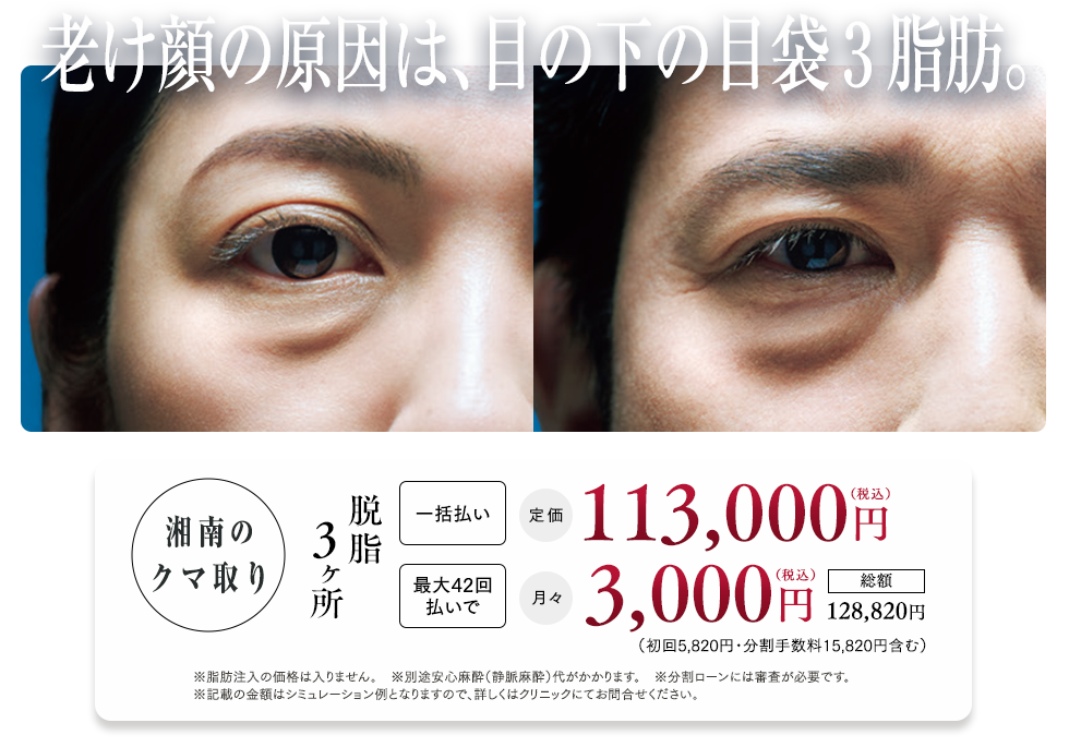 目の下の切らないクマ・たるみ（ふくらみ）取り