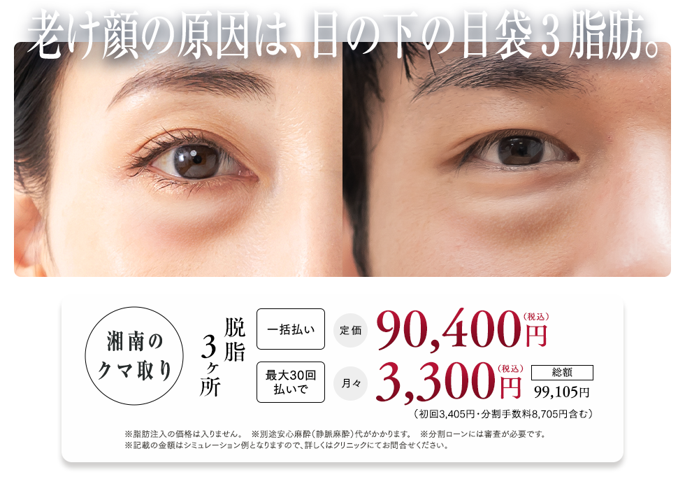 目の下の切らないクマ・たるみ（ふくらみ）取り