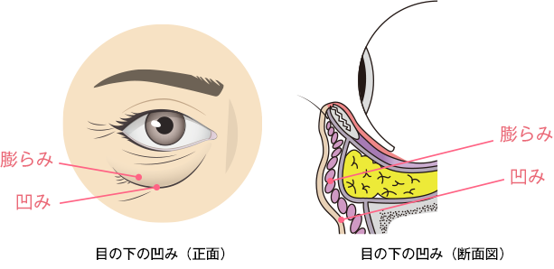 目の下は膨らみと凹みが混在