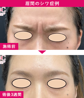 Yellシワ 症例3