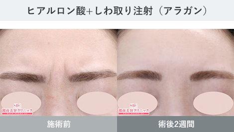 しわ 症例写真3